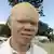 Албиносите в Африка са дискриминирани